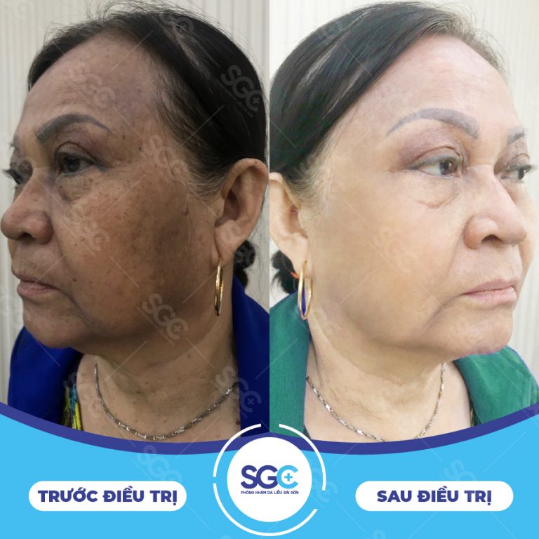 TRỊ NÁM CHUẨN Y KHOA VỚI MELAS PICOSTAR – DỨT ĐIỂM NÁM TÀN NHANG CHỈ DUY NHẤT 1 LIỆU TRÌNH